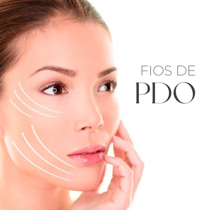 Uma técnica de lifting facial que envolve a inserção de fios de polidioxanona na pele para criar um efeito lifting imediato e estimular a produção de colágeno a longo prazo.